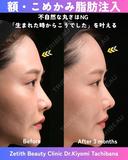 額・こめかみ脂肪注入 90日後 サムネイル用