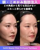 額・こめかみ脂肪注入 90日後 サムネイル用