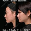 肋軟骨による鼻整形 180日後 サムネイル用