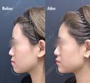 アゴヒアルロン酸 before画像 サムネイル用