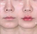 唇ヒアルロン酸 before画像 サムネイル用