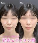 貴族ヒアルロン酸 before画像 サムネイル用