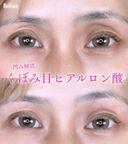 目の上ヒアルロン酸 before画像 サムネイル用