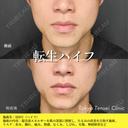 転生ハイフ after画像 サムネイル用