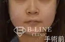 【小鼻縮小術】手術直後 before画像 サムネイル用