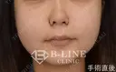 【小鼻縮小術】手術直後 after画像 サムネイル用
