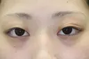 フォーエバーブリリアント埋没法 before画像 サムネイル用
