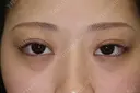 フォーエバーブリリアント埋没法 after画像 サムネイル用