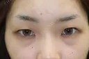 フォーエバーブリリアント埋没法 before画像 サムネイル用