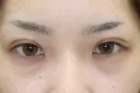 フォーエバーブリリアント埋没法 after画像 サムネイル用