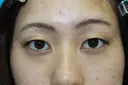 フォーエバーブリリアント埋没法 before画像 サムネイル用