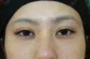 フォーエバーブリリアント埋没法 after画像 サムネイル用
