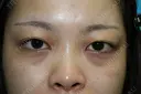 フォーエバーブリリアント埋没法 before画像 サムネイル用