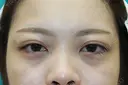 フォーエバーブリリアント埋没法 after画像 サムネイル用