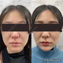 フェイスライン改善セット→引き上げスレッド6本＋ショッピングスレッド20本＋ヒアルロン酸1本 before画像 サムネイル用
