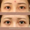 下眼瞼拡大（グラマラスライン）、目尻切開 before画像 サムネイル用