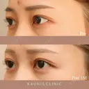 下眼瞼拡大（グラマラスライン）、目尻切開 after画像 サムネイル用