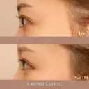 下眼瞼拡大（グラマラスライン）、目尻切開 after画像 サムネイル用
