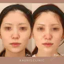 鼻中隔延長 after画像 サムネイル用