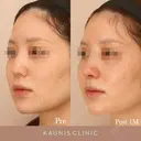 鼻中隔延長 after画像 サムネイル用