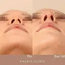 鼻中隔延長 after画像 サムネイル用