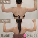 脂肪吸引 before画像 サムネイル用