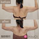 脂肪吸引 after画像 サムネイル用