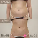 脂肪吸引 after画像 サムネイル用