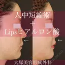美ライン💋人中短縮術(リップリフト)＋Lipsヒアルロン酸注入 before画像 サムネイル用