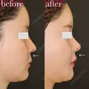 美ライン💋人中短縮術(リップリフト)＋Lipsヒアルロン酸注入 after画像 サムネイル用