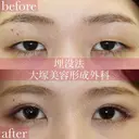 フォーエバーブリリアント法💫二重埋没💫 before画像 サムネイル用