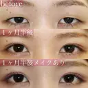 フォーエバーブリリアント法💫二重埋没💫 14日後 サムネイル用
