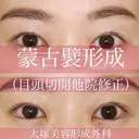 ナチュラルなデカ目💗蒙古襞形成(目頭切開他院修正) before画像 サムネイル用