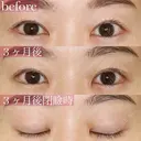 ナチュラルなデカ目💗蒙古襞形成(目頭切開他院修正) 90日後 サムネイル用