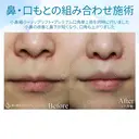 【30代女性・鼻から口元の印象の改善】小鼻縮小+リップリフト+プレミアムスマイル切開術 before画像 サムネイル用