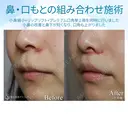 【30代女性・鼻から口元の印象の改善】小鼻縮小+リップリフト+プレミアムスマイル切開術 30日後 サムネイル用