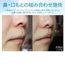 【30代女性・鼻から口元の印象の改善】小鼻縮小+リップリフト+プレミアムスマイル切開術 30日後 サムネイル用
