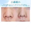 【10代女性・小鼻を小さく】小鼻縮小術 before画像 サムネイル用