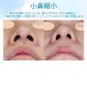 【10代女性・小鼻を小さく】小鼻縮小術 30日後 サムネイル用