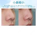 【10代女性・小鼻を小さく】小鼻縮小術 30日後 サムネイル用