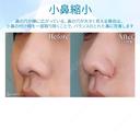 【10代女性・小鼻を小さく】小鼻縮小術 30日後 サムネイル用
