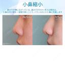 【10代女性・小鼻を小さく】小鼻縮小術 30日後 サムネイル用