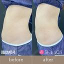 脂肪吸引 before画像 サムネイル用