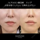リップヒアルロン酸 before画像 サムネイル用