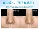 【20代女性・耳介軟骨は不要】鼻尖縮小術+α法（1ヶ月後） before画像 サムネイル用