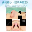 【20代女性・耳介軟骨は不要】鼻尖縮小術+α法（1ヶ月後） 30日後 サムネイル用