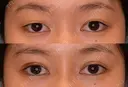 切開式二重 90日後 サムネイル用