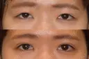 切開式二重 60日後 サムネイル用