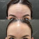 額ボトックス（アラガン） before画像 サムネイル用