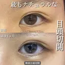 韓流目頭切開 before画像 サムネイル用